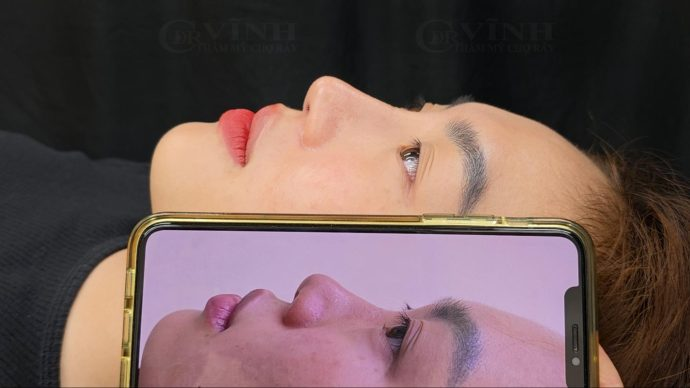 Hình ảnh trước và sau nâng mũi của khách hàng tại Phòng khám Thẩm mỹ Tiến sĩ Vĩnh - Chợ Rẫy