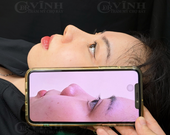 Khách hàng sau nâng mũi với dáng mũi ổn định và hài hòa khuôn mặt