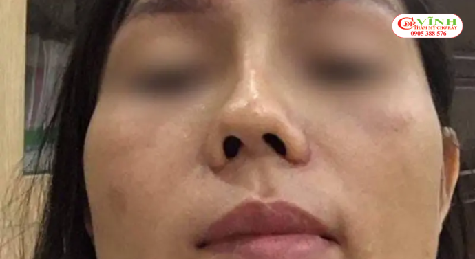 Biến chứng lệch sóng mũi sau nâng mũi