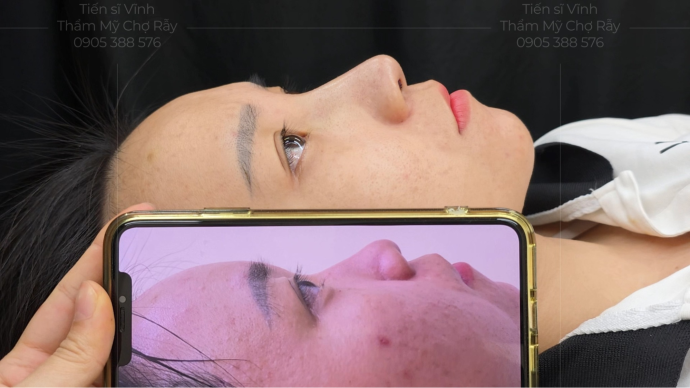 Hình ảnh trước và sau nâng mũi tại Phòng khám Thẩm mỹ Tiến sĩ Vĩnh - Chợ Rẫy