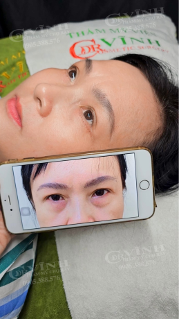 Hình ảnh trước và sau khi lấy mỡ bọng mắt tại Phòng khám Thẩm mỹ Tiến sĩ Vĩnh - Chợ Rẫy