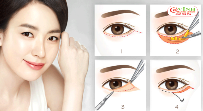 Cấu trúc mí mắt dưới